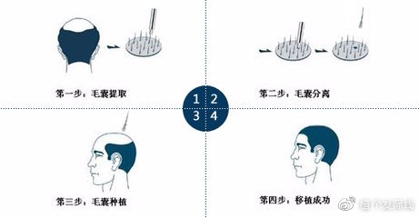 最新织发补发技术，重塑自信，焕发新生