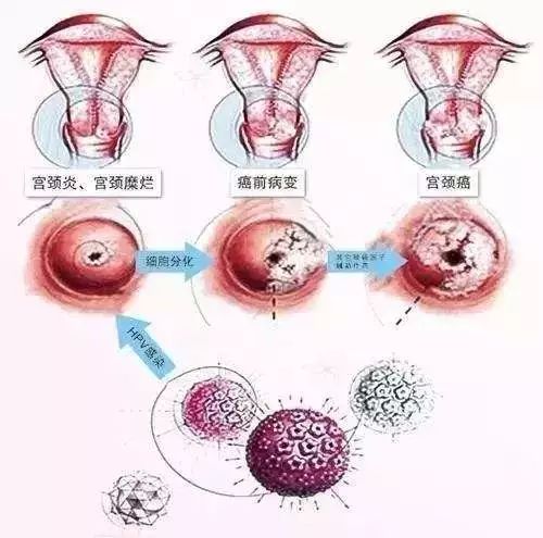 HPV最新分型，探索人类乳头瘤病毒的奥秘